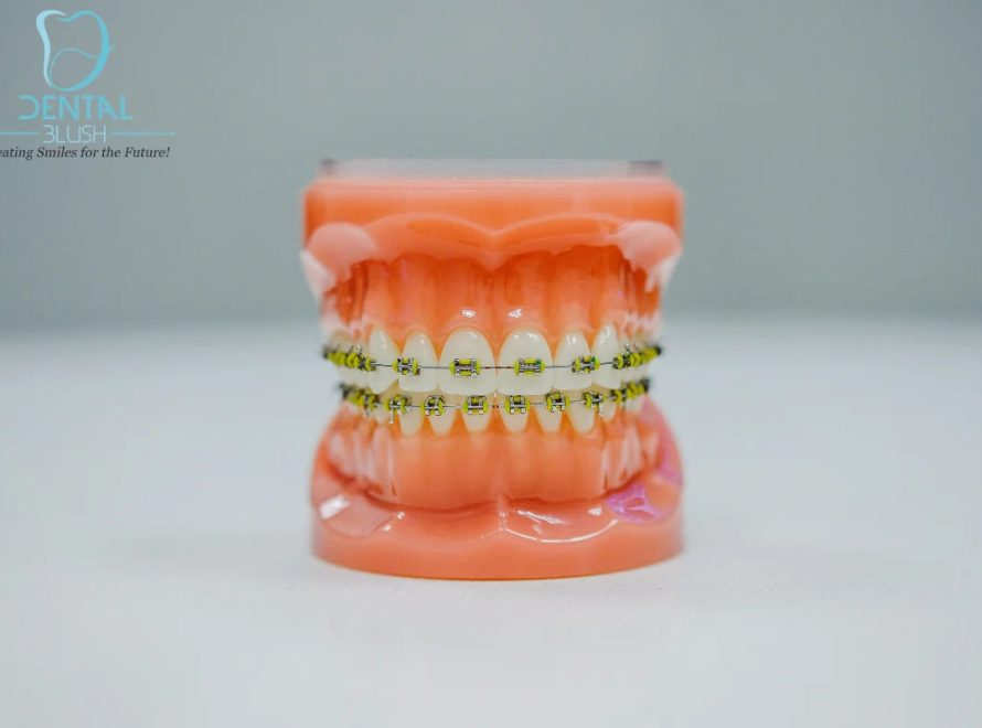 Recommended-Foods-During-Braces-Treatment