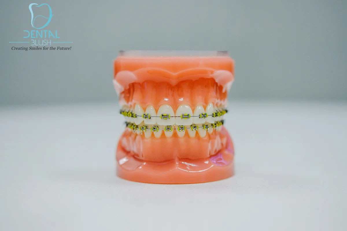 Recommended-Foods-During-Braces-Treatment
