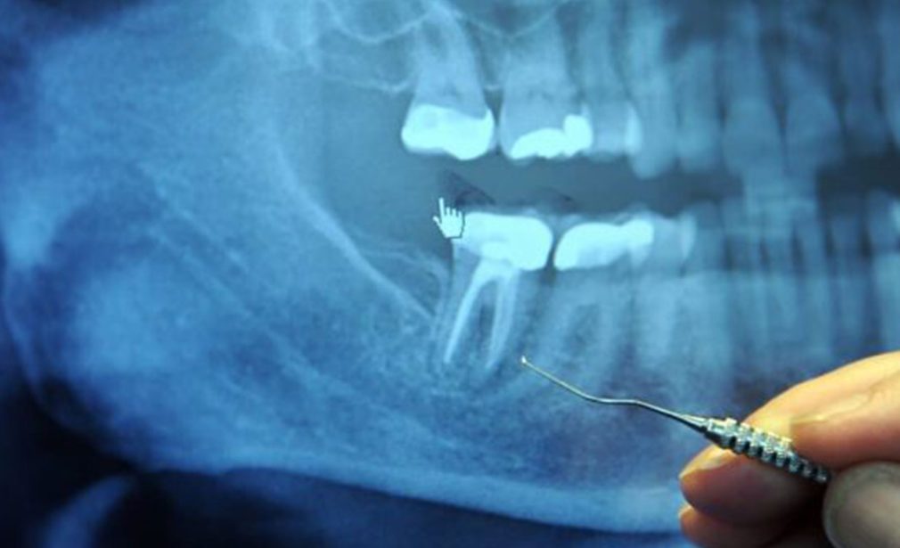 Root canal in Miami at Dental Blush