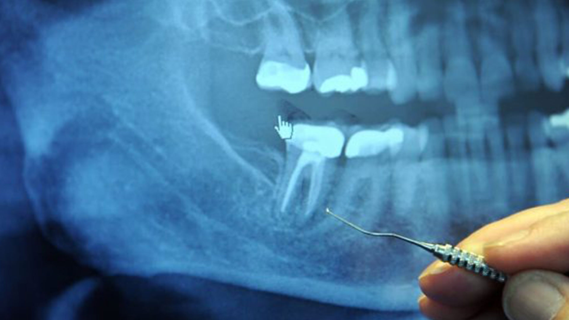 Root Canal in Miami at Dental Blush Tamiami Root canal in Miami at Dental Blush Tamiami