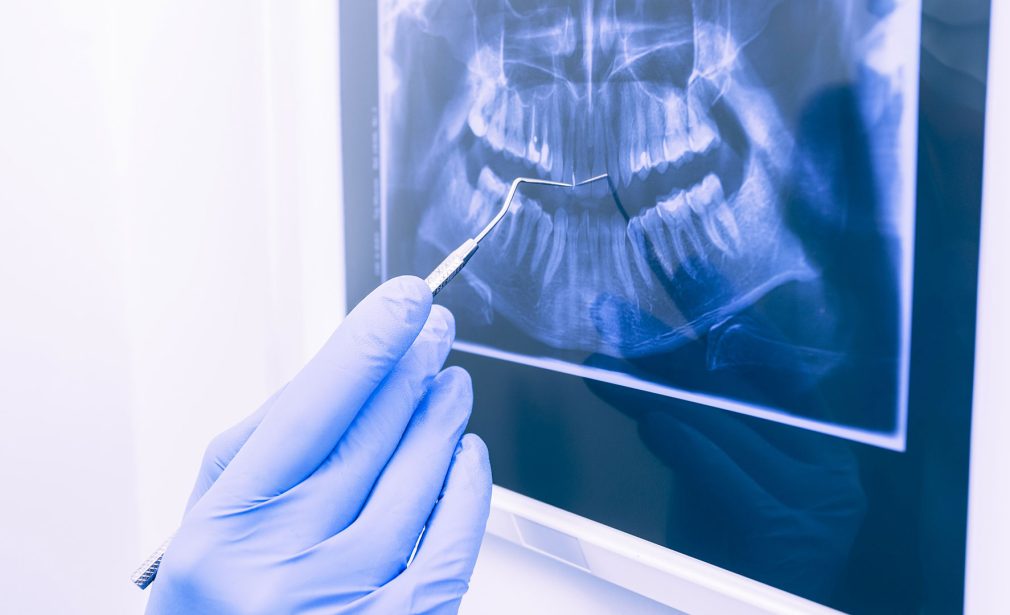 Digital dental radiographs in Miami Tamiami for accurate diagnosis
