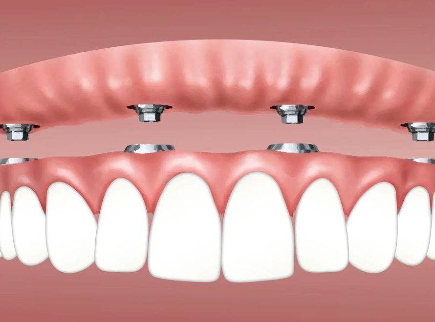 Benefits of Dental Implants- Dental Blush
