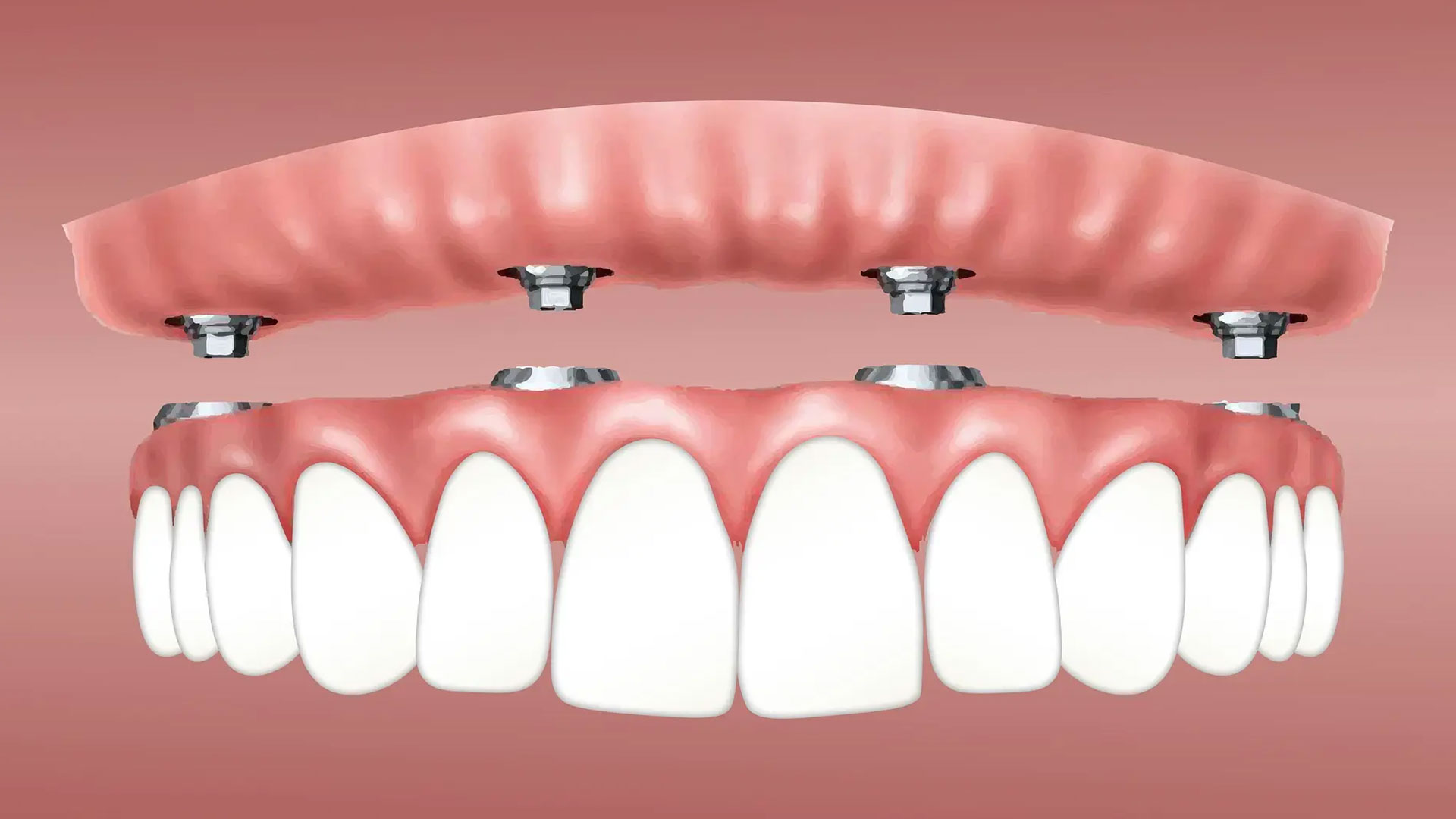 Benefits of Dental Implants- Dental Blush