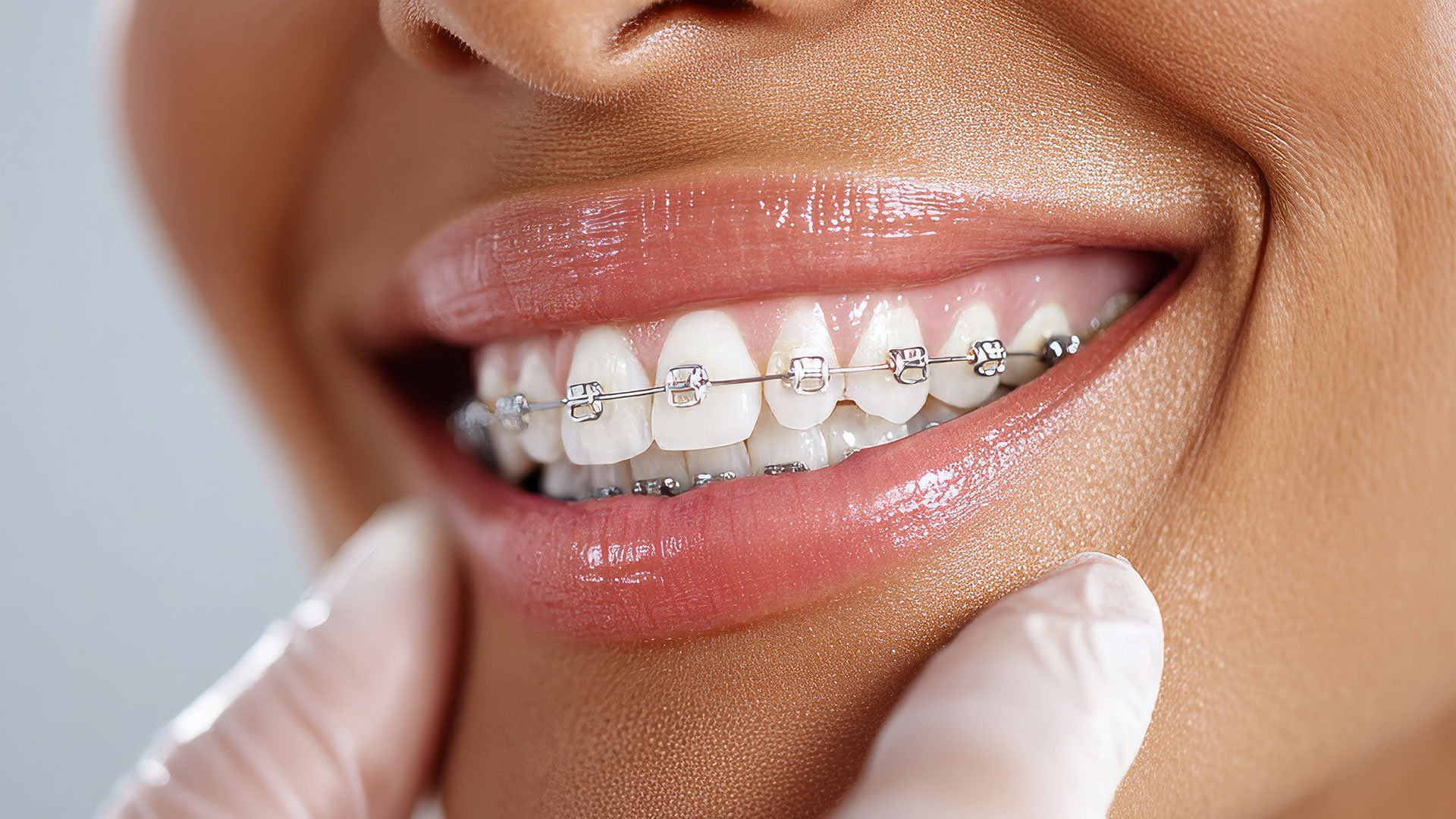 Affordable Braces in Tamiami – Dental Blush Miami offers affordable orthodontic treatment with braces and flexible financing options.