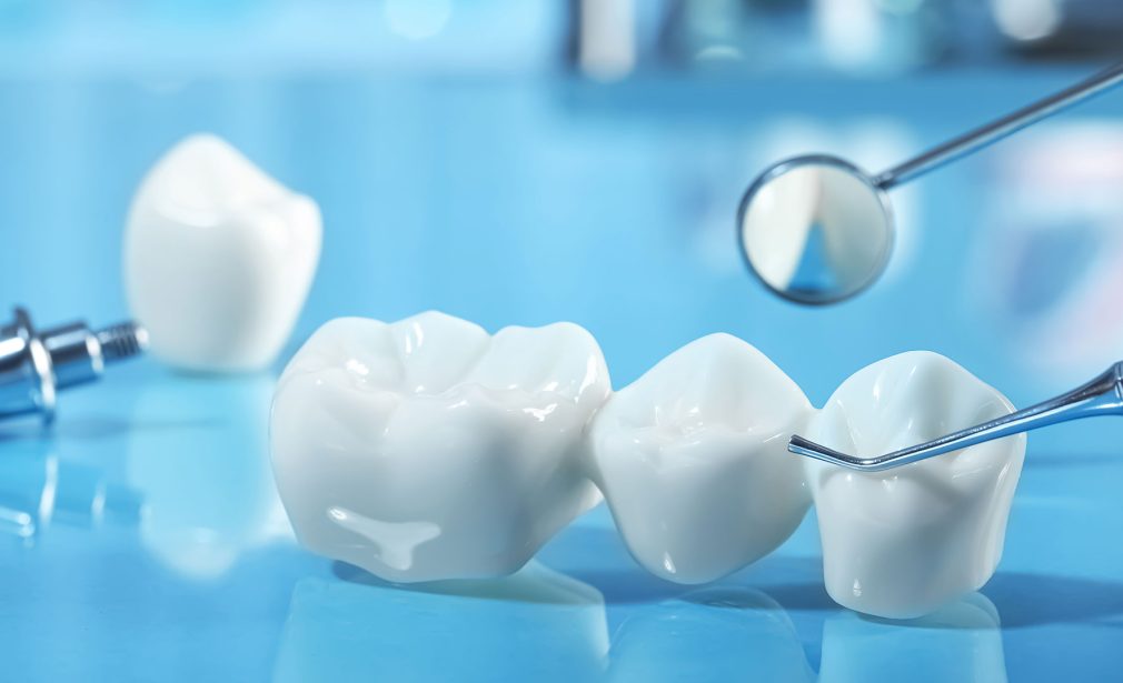 Dental crowns in Miami restoring damaged teeth at Dental Blush Tamiami dental clinic