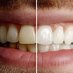 Opciones de diseño de sonrisa en Miami en Dental Blush