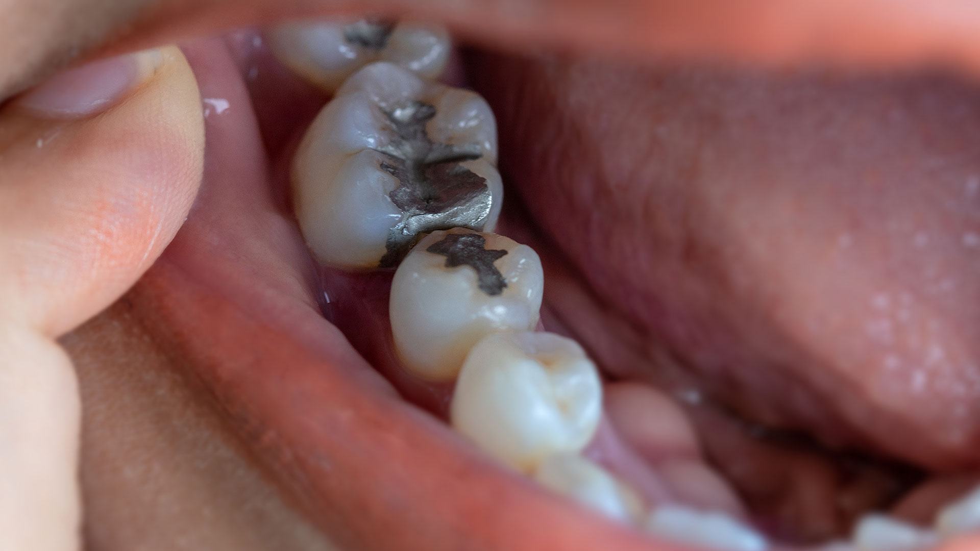 Dental Fillings Miami at Dental Blush Tamiami Dental Fillings Miami at Dental Blush Tamiami