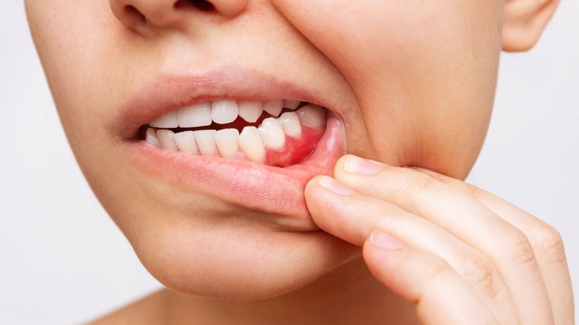Treatment for Bleeding Gums in Miami at Dental Blush Tamiami Treatment for bleeding gums in Miami at Dental Blush Tamiami
